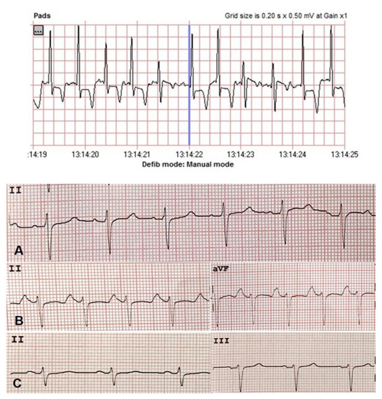 cardiac-arrest-due-to-hypocalcemia-international-journal-of